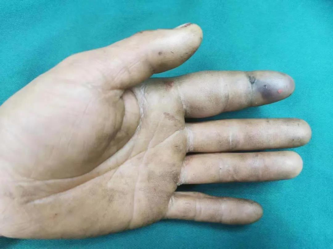 注意！手指被柴油“射”中，一船員差點(diǎn)要被截指！